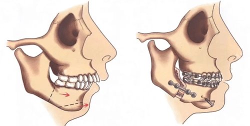 雙顎手術細節(jié)動畫圖