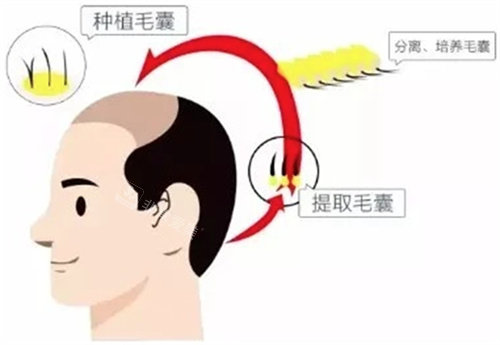 种植毛囊图 种植毛囊图