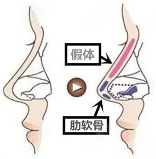 假体隆鼻图 假体隆鼻图