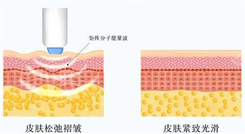 熱瑪吉工作原理圖 熱瑪吉工作原理圖