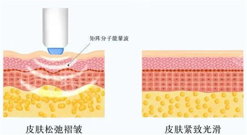 热玛吉工作原理图