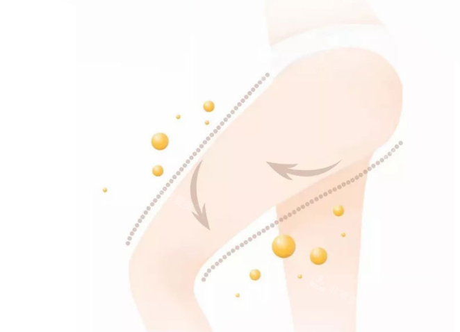 大腿吸脂動(dòng)畫(huà)圖 大腿吸脂動(dòng)畫(huà)圖