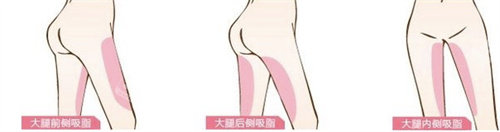 大腿吸脂部位展示圖 大腿吸脂部位展示圖