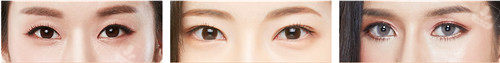 韩国大眼睛整形眼部手术术后图