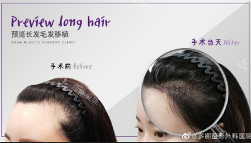 韓國多娜整形外科女性植發(fā)手術(shù)對比 韓國多娜整形外科女性植發(fā)手術(shù)對比