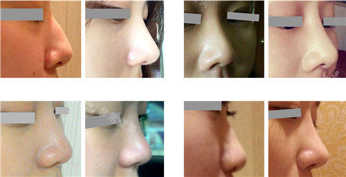 韩国wil整形鼻子术后图片