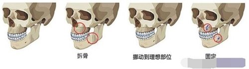 雙鄂手術(shù)過程圖