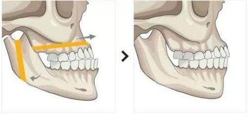 双鄂手术