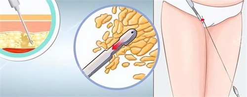 大腿吸脂手术动画图 大腿吸脂手术动画图