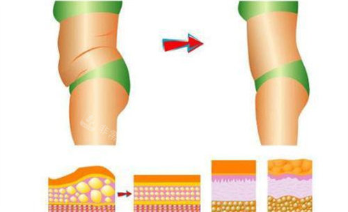 腰腹吸脂前后对比图 腰腹吸脂前后对比图