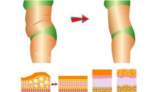 腰腹吸脂前后对比图