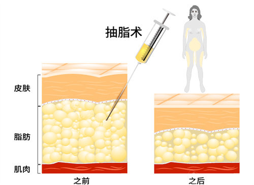 抽脂前后脂肪层变化图 抽脂前后脂肪层变化图
