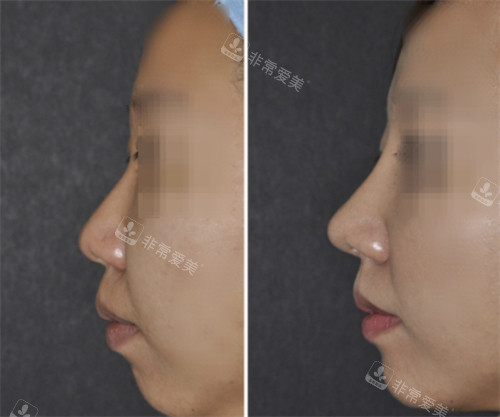 韩国魏亨坤隆鼻实例:鼻综合/高难度鼻修复手术风格不华丽!