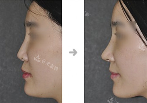 韩国Will整形外科鼻整形前后图