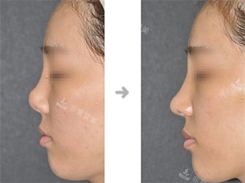韩国Will整形外科朝天鼻矫正对比