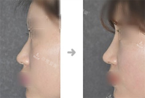 韩国Will整形外科鼻整形前后对比照