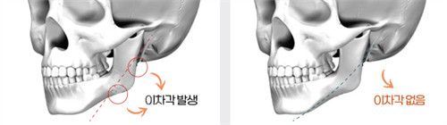 韩国欧佩拉整形下颌手术细节图