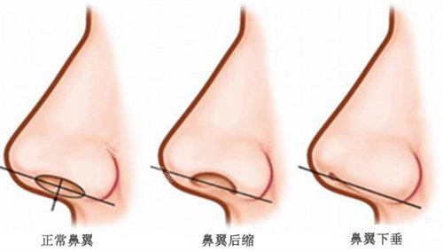 鼻翼的三种不同形状 鼻翼的三种不同形状