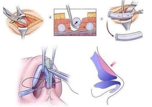 自体软骨隆鼻过程图