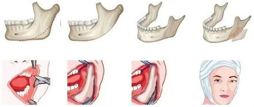 面部輪廓手術(shù)過程演示圖