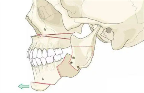 下巴手术动画演示图
