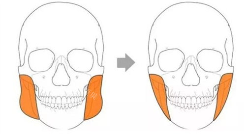 下颌角手术前后动画对比图