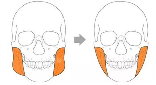 下頜角手術(shù)前后動畫對比圖