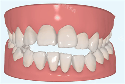 牙齿矫正图