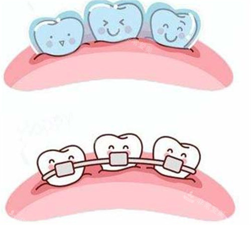 牙齿矫正形象图