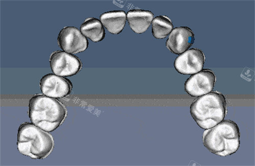 牙齿矫正展示图