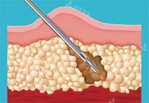 吸脂术图片