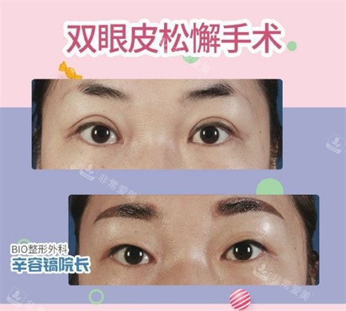 辛容鎬單眼皮復(fù)原術(shù)前后圖 辛容鎬單眼皮復(fù)原術(shù)前后圖