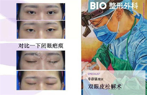 辛容鎬眼睛松解術(shù)修復(fù)對(duì)比照 辛容鎬眼睛松解術(shù)修復(fù)對(duì)比照