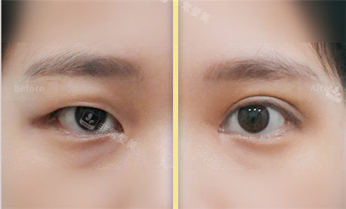 韩国yellow整形眼部手术图