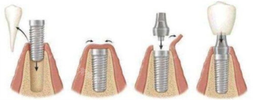 种植牙过程图