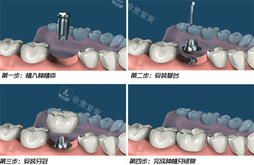 种植牙手术流程图