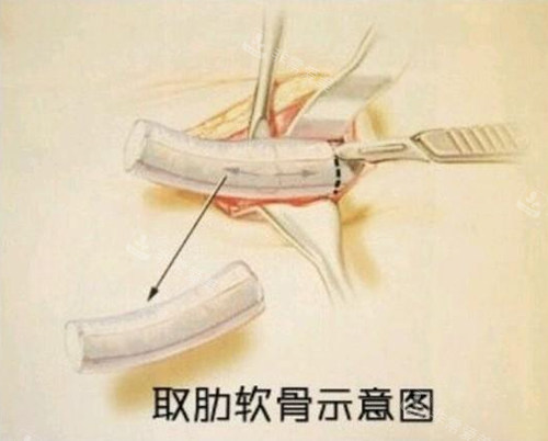 取肋軟骨示意圖 取肋軟骨示意圖