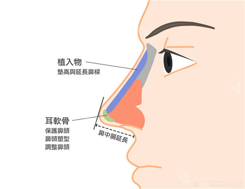 耳軟骨隆鼻圖示 耳軟骨隆鼻圖示