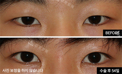 韩国爱护整形外科眼整形前后图