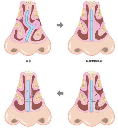 鼻中隔彎曲 鼻中隔彎曲