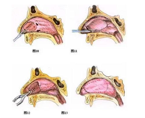 鼻中隔弯曲形象图