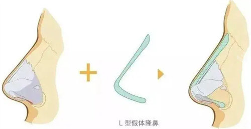 假体隆鼻图 假体隆鼻图