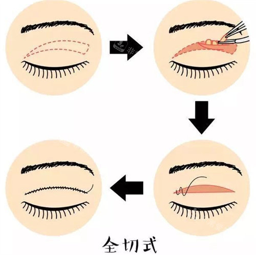 全切式双眼皮图 全切式双眼皮图