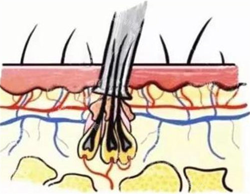 毛囊图