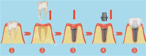 种植牙过程图