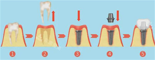 種植牙過程圖