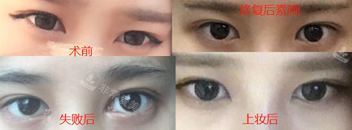 韓國eve整形眼部修復(fù)手術(shù)圖
