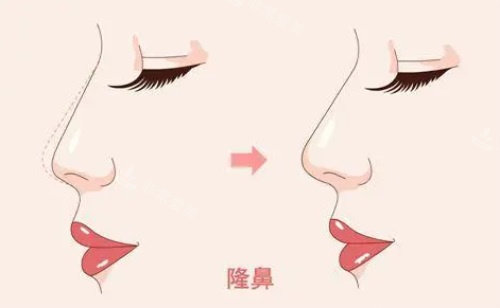 假體隆鼻示意圖 假體隆鼻示意圖