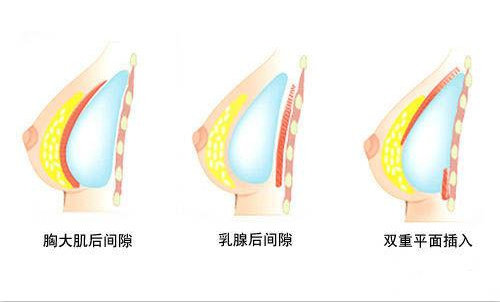 隆胸植入方式示意图