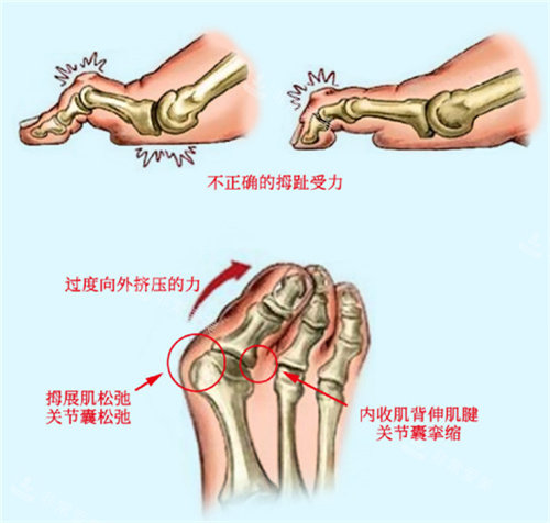 大腳骨形成原因